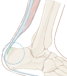 Pijnklachten rond de achillespees
